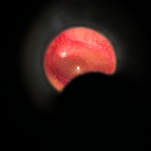  Диагностический отоскоп BETA 100 - яркое ксенон-галогеновое освещение