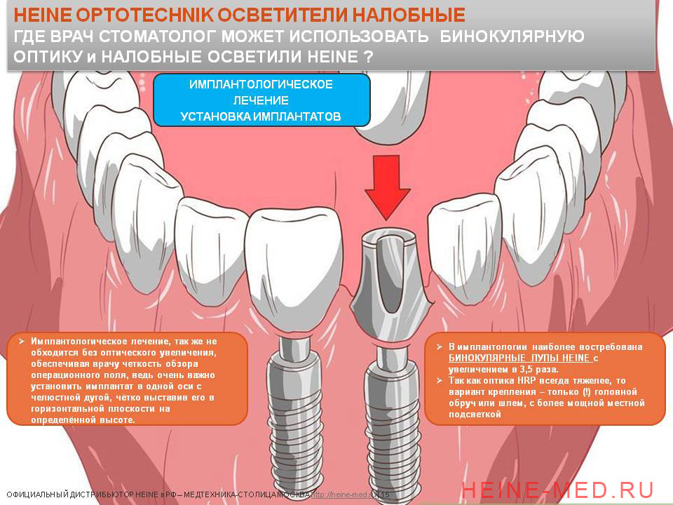Бинокулярные лупы HR для стоматологов